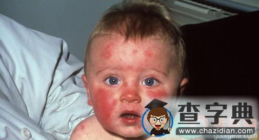 婴儿传染性红斑的病因和症状