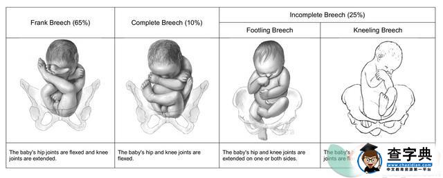 胎位臀位如何分娩 胎位臀位分娩步骤2