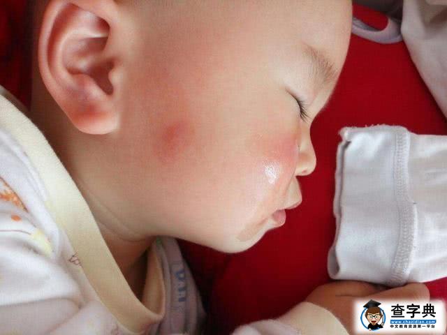 儿科医生：宝宝被蚊虫叮咬后，别再这样做了，大部分家长都搞错了5